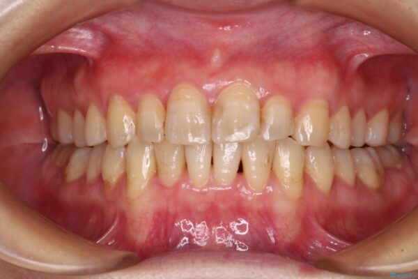 前歯のデコボコと奥歯のクロスバイト　インビザラインで改善 アフター