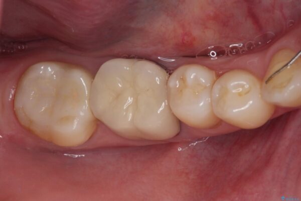 奥歯に物が挟まる　セラミックインレーによる虫歯治療 アフター