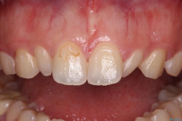 結婚式までに前歯をきれいに　オールセラミッククラウンの審美歯科治療 治療前画像