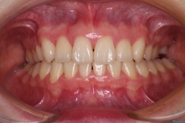 上顎のみの抜歯矯正　前歯のデコボコを改善する アフター