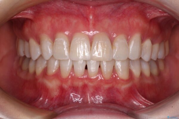 前歯の突出感とデコボコをインビザライン矯正で改善 アフター