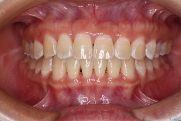 前歯の隙間と上下正中のズレを解消 アフター