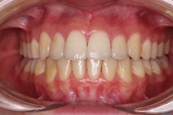 【モニター】前歯の前突感とクロスバイトをインビザラインで改善 アフター
