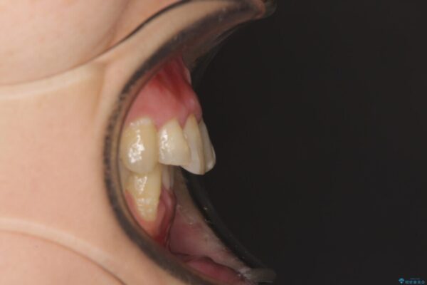 前歯のデコボコと奥歯のクロスバイト　インビザラインで改善 治療前画像