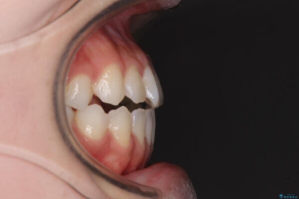 舌突出癖で口元が開いてしまう　舌トレーニングを行ったインビザライン矯正 治療前画像