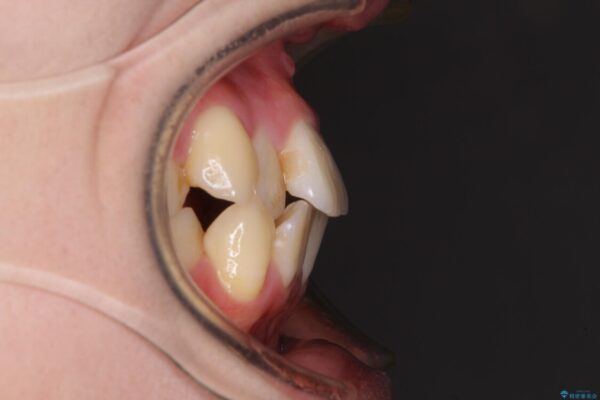 【モニター】前歯の前突感とクロスバイトをインビザラインで改善 治療前画像