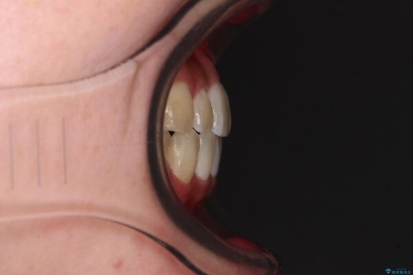 すきっ歯とオープンバイトをインビザラインで改善 治療途中画像