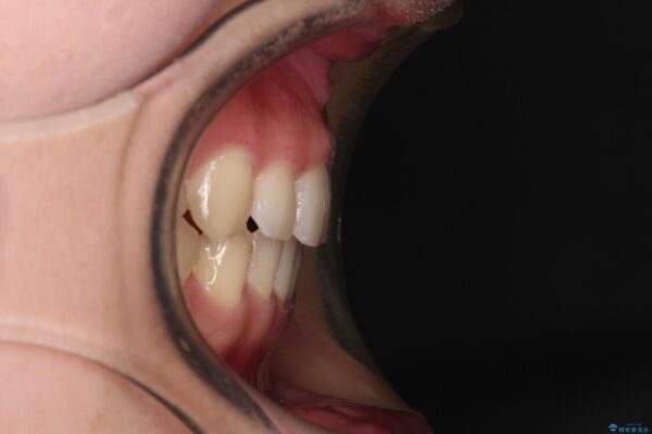捻れた前歯と銀歯のブリッジを治したい　ワイヤー矯正とオールセラミックブリッジ 治療後画像