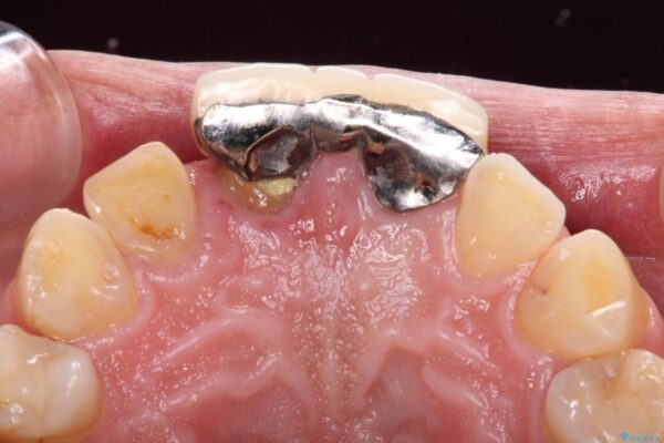 不自然な前歯　歯肉移植を用いた前歯のオールセラミックブリッジ 治療前画像