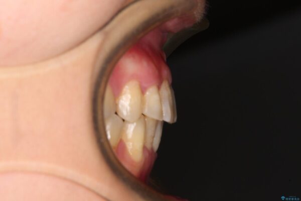 前歯のデコボコと奥歯のクロスバイト　インビザラインで改善 治療後画像