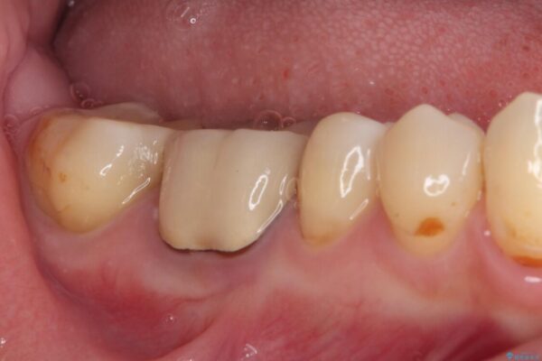 奥歯に物が挟まる　セラミックインレーによる虫歯治療 治療後画像
