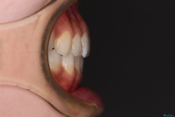 舌突出癖で口元が開いてしまう　舌トレーニングを行ったインビザライン矯正 治療後画像