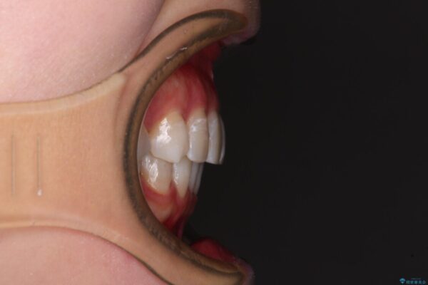 前歯の突出感とデコボコをインビザライン矯正で改善 治療後画像