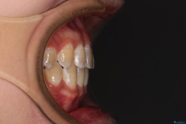 前歯の隙間と上下正中のズレを解消 治療後画像