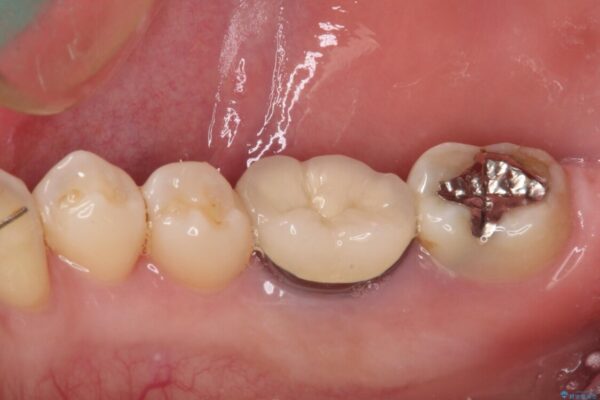 奥歯に物が挟まる　セラミックインレーによる虫歯治療 治療前画像