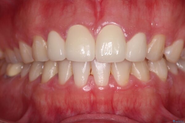 結婚式までに前歯をきれいに　オールセラミッククラウンの審美歯科治療 治療後画像