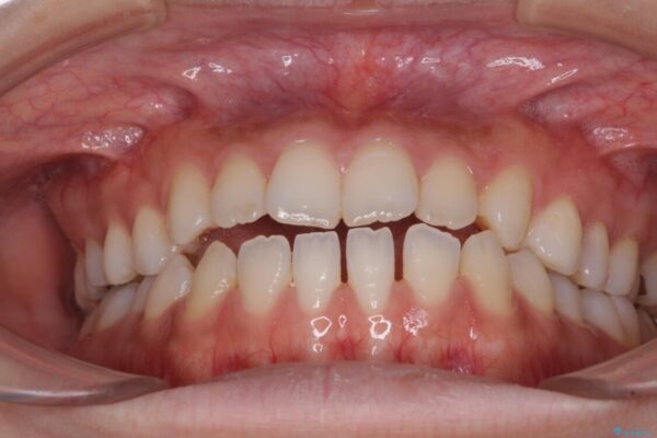 舌突出癖で口元が開いてしまう　舌トレーニングを行ったインビザライン矯正 治療前画像
