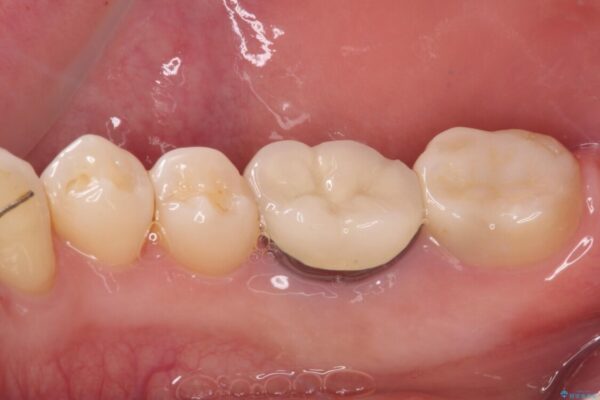 奥歯に物が挟まる　セラミックインレーによる虫歯治療 治療後画像