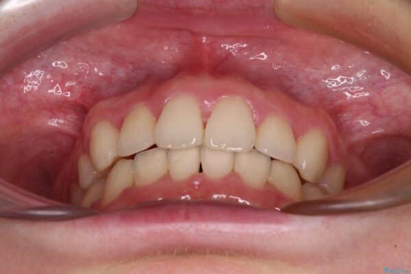 上顎のみの抜歯矯正　前歯のデコボコを改善する 治療後画像