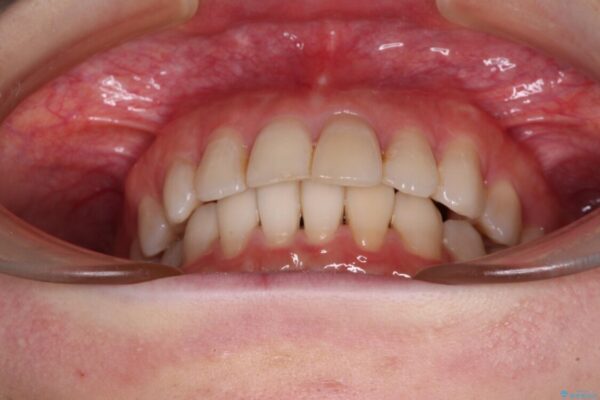 前歯の突出感とデコボコをインビザライン矯正で改善 治療途中画像