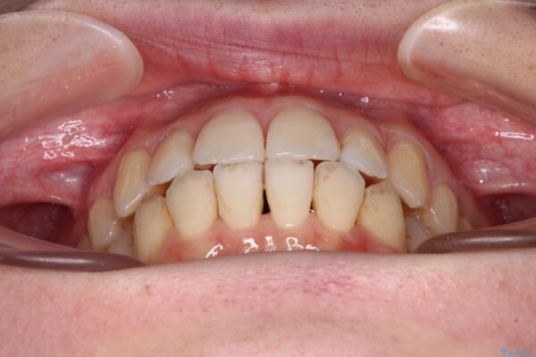 【モニター】前歯の前突感とクロスバイトをインビザラインで改善 治療途中画像