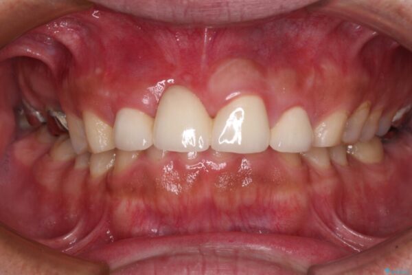 不自然な前歯　歯肉移植を用いた前歯のオールセラミックブリッジ 治療後画像