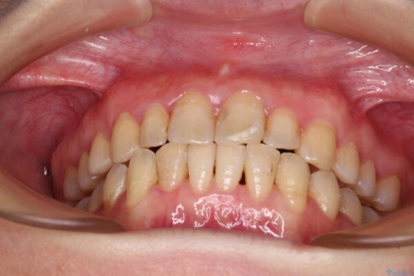 前歯のデコボコと奥歯のクロスバイト　インビザラインで改善 治療後画像