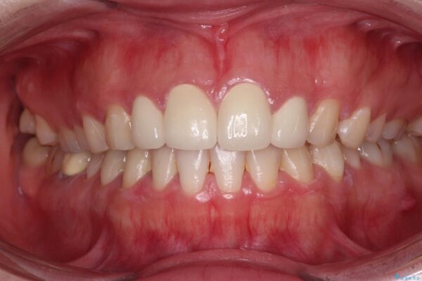 結婚式までに前歯をきれいに　オールセラミッククラウンの審美歯科治療 治療後画像