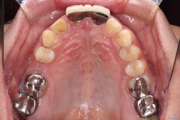 不自然な前歯　歯肉移植を用いた前歯のオールセラミックブリッジ 治療前画像
