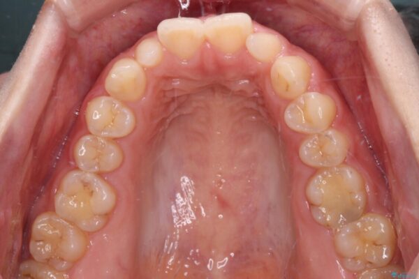 結婚式までに前歯をきれいに　オールセラミッククラウンの審美歯科治療 治療前画像