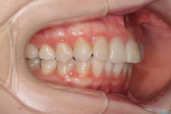 前歯の突出感とデコボコをインビザライン矯正で改善 治療前画像
