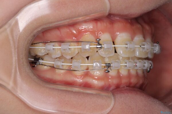 前歯の隙間と上下正中のズレを解消 治療途中画像