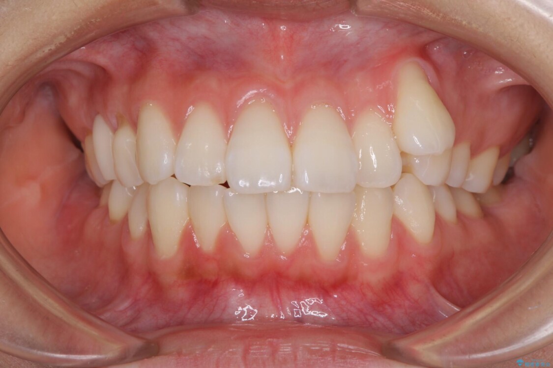【モニター】気になる八重歯を素早く改善　ワイヤー装置での抜歯矯正 治療前