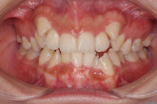 著しい八重歯が気になる　インビザラインによる抜歯矯正治療(ワイヤー装置併用) ビフォー