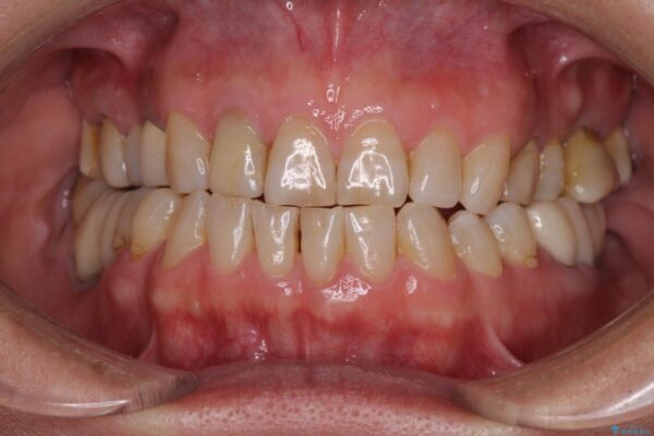 憧れの白い歯に　全顎セラミック治療 治療前画像