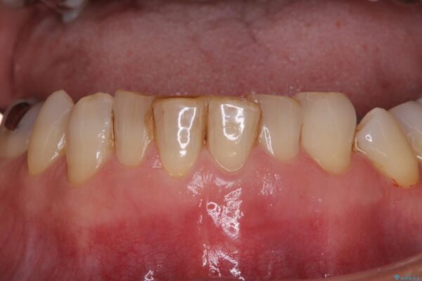 抜歯が必要と言われた前歯　根管治療とオールセラミッククラウン 治療前画像