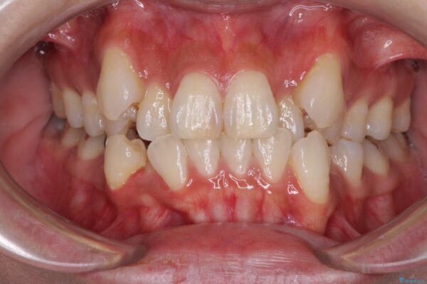 気になる八重歯を目立たない装置で改善　ハーフリンガル矯正 治療前画像