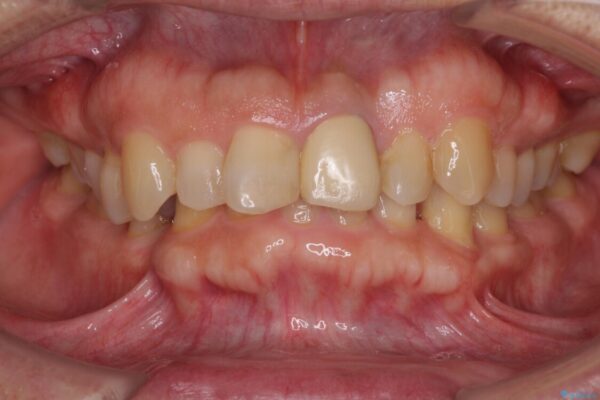 欠損歯列の矯正治療とインプラント治療 ビフォー