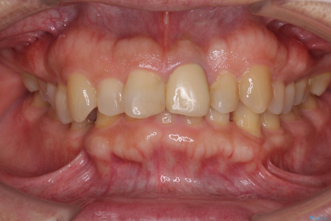 欠損歯列の矯正治療とインプラント治療 治療前