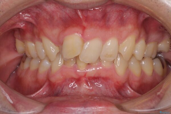 前歯が折れたついでに歯並びも改善　矯正治療と前歯のセラミック治療 ビフォー