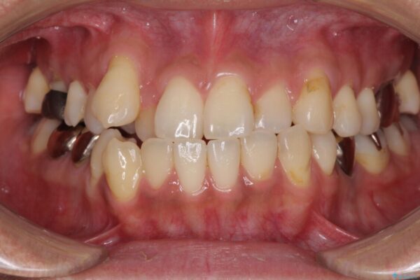 前歯のクロスバイトを改善　インビザライン矯正 治療前画像
