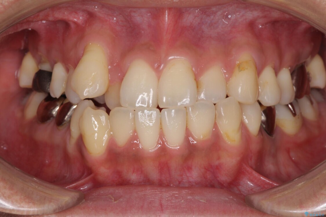 前歯のクロスバイトを改善　インビザライン矯正 治療前