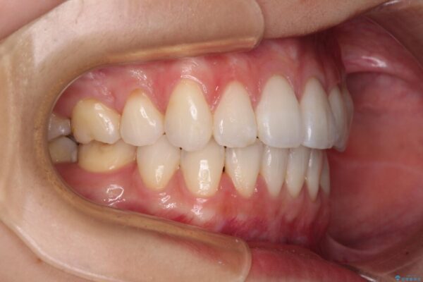 【モニター】気になる八重歯を素早く改善　ワイヤー装置での抜歯矯正 治療後画像