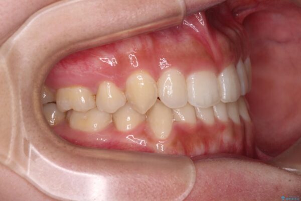 著しい八重歯が気になる　インビザラインによる抜歯矯正治療(ワイヤー装置併用) 治療途中画像