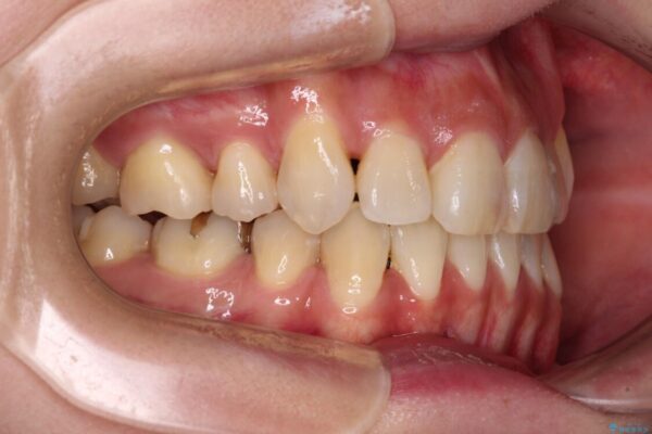 気になる八重歯を目立たない装置で改善　ハーフリンガル矯正 治療後画像