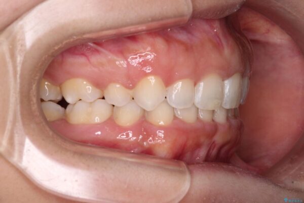 口がしっかりと閉じられない　ワイヤー装置での抜歯矯正で出っ歯を改善 治療後画像