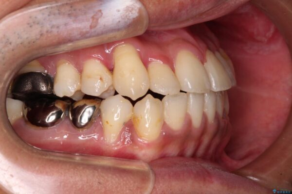 前歯のクロスバイトを改善　インビザライン矯正 治療途中画像