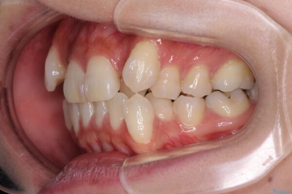 気になる八重歯を目立たない装置で改善　ハーフリンガル矯正 治療前画像