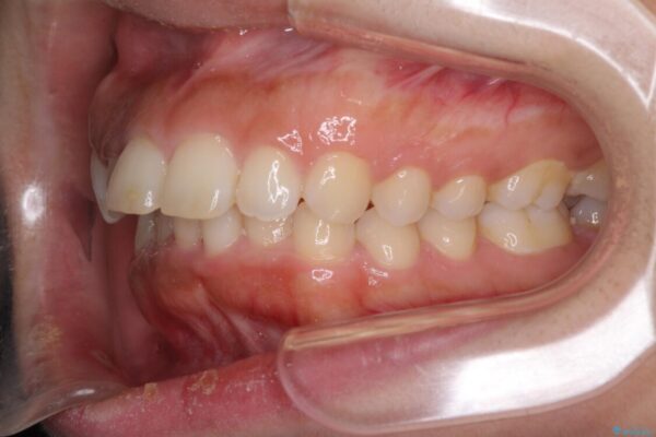 口がしっかりと閉じられない　ワイヤー装置での抜歯矯正で出っ歯を改善 治療前画像