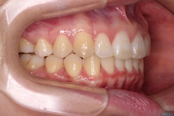 【モニター】すきっ歯をインビザラインで解消 治療後画像